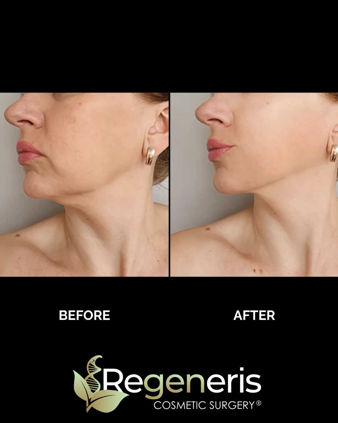 Before and after chin liposuction showing side profile with reduced submental fat and defined chin-neck angle