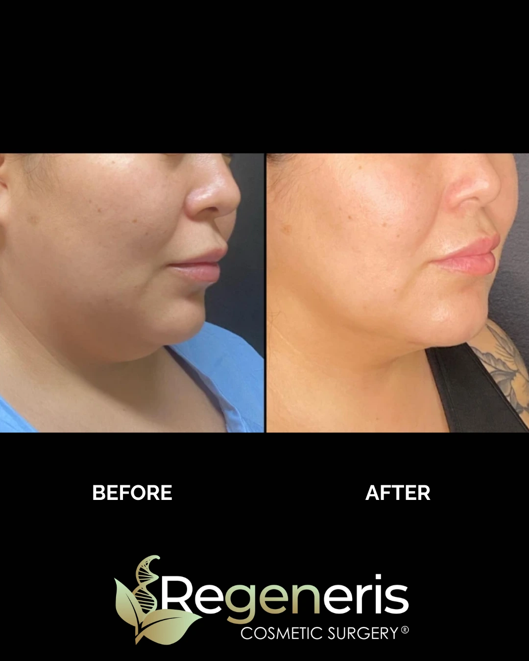 Before and after chin liposuction, profile view showing reduced submental fullness