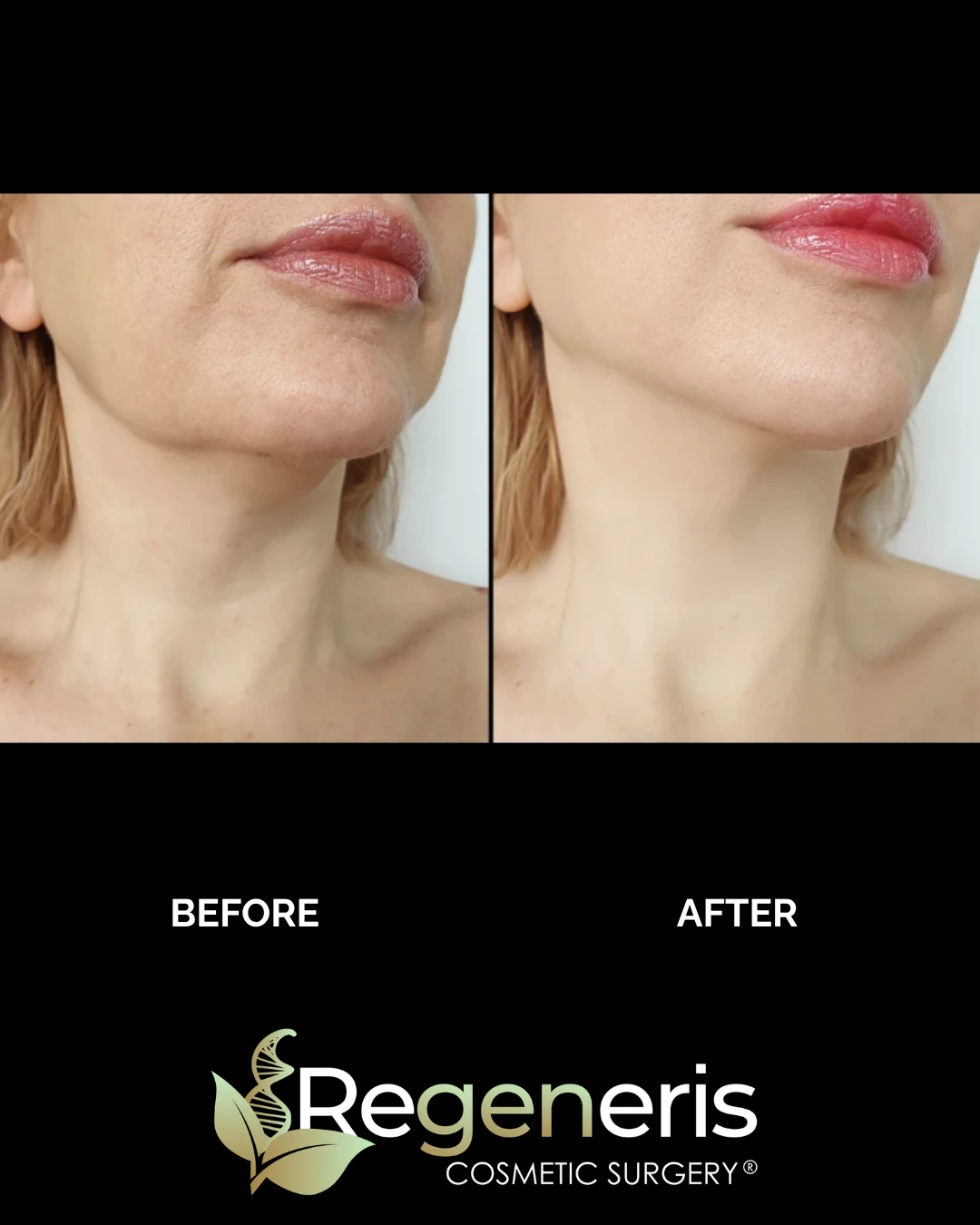 Before and after chin liposuction, three-quarter view showing improved jawline definition