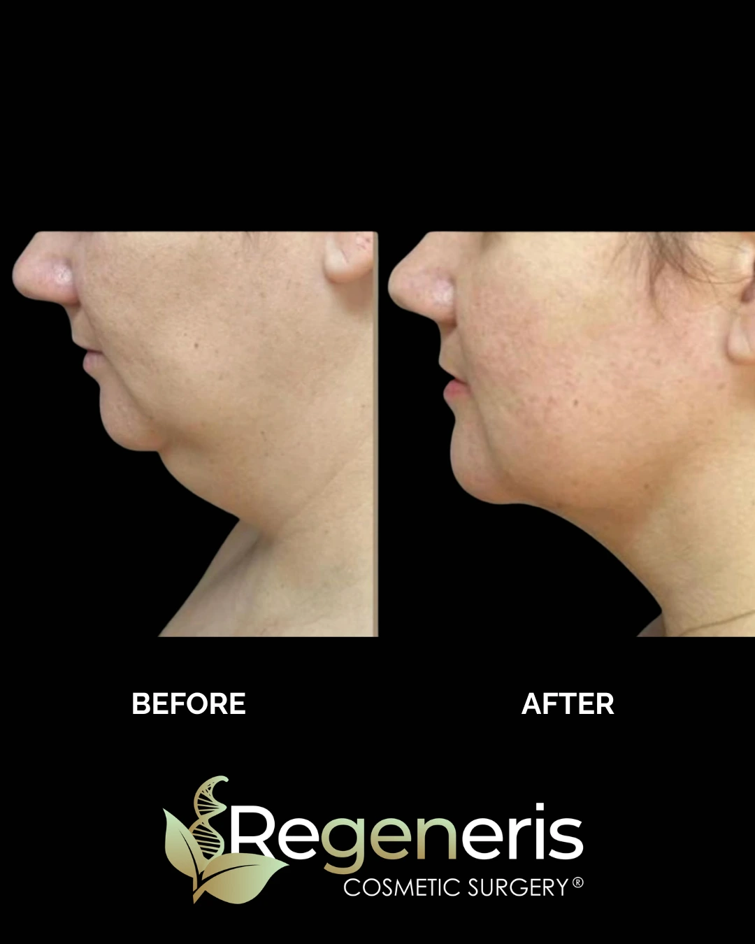 Before and after chin liposuction, side profile showing sharper chin contour