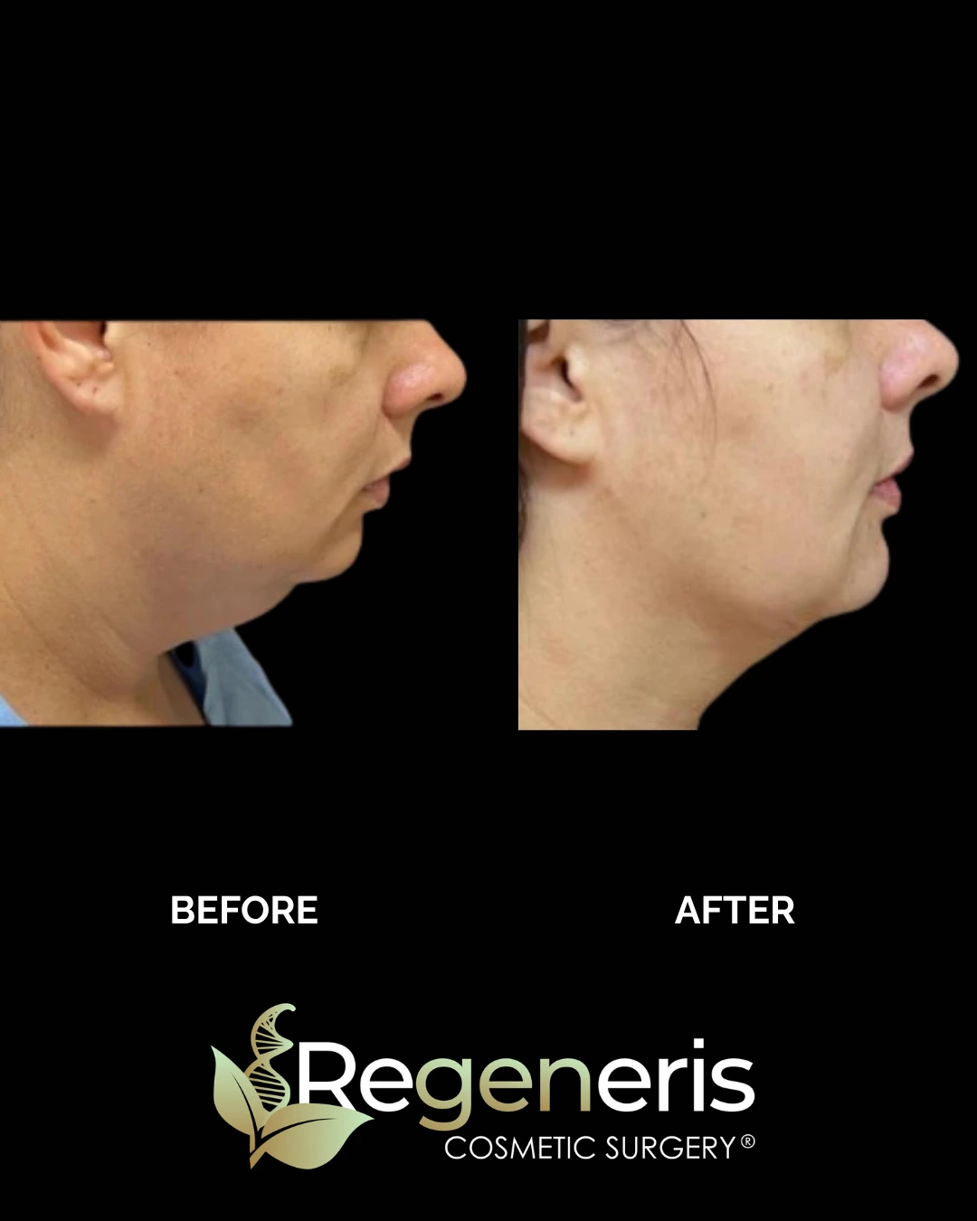 Before and after chin liposuction, profile view showing enhanced chin projection