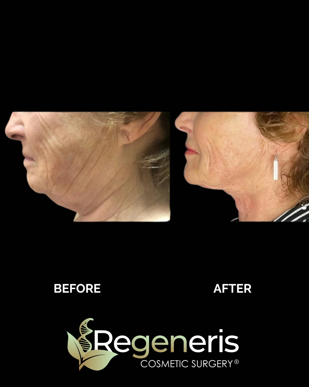 Before and after chin liposuction, side profile showing tightened neck and jawline