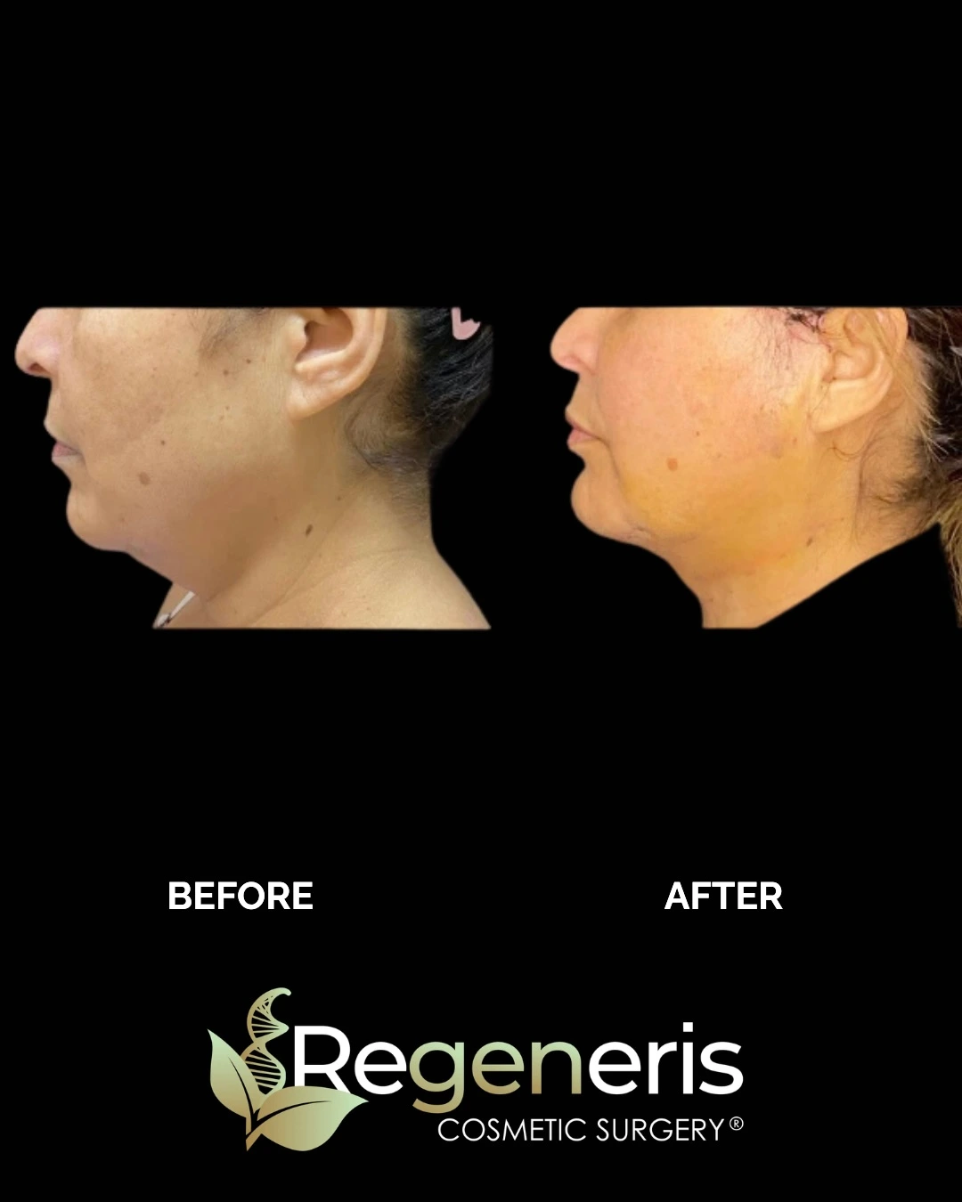 Before and after chin liposuction, profile view showing improved neck contour