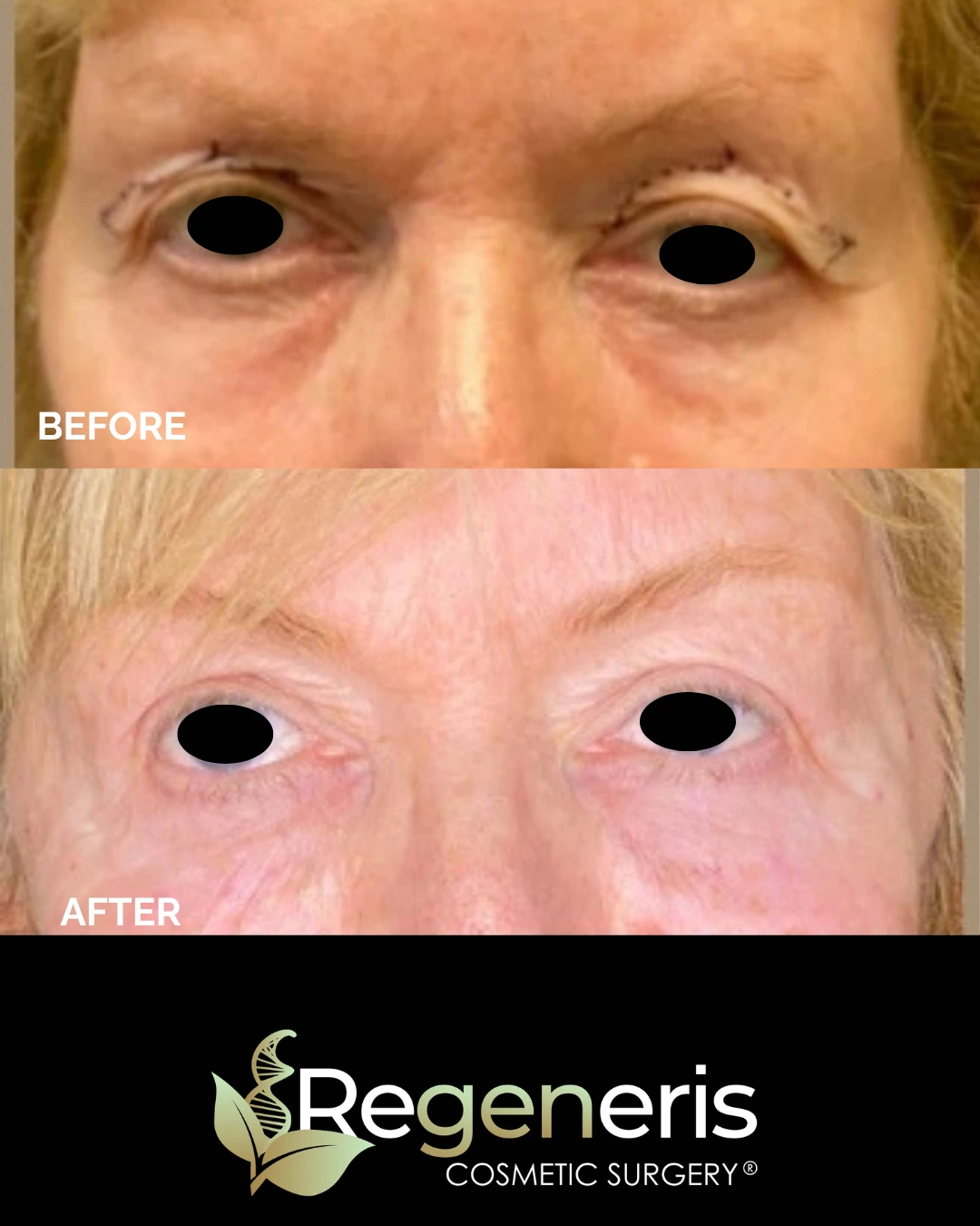 Before and after eyelid surgery comparison showing improved eyelid contour and reduced sagging