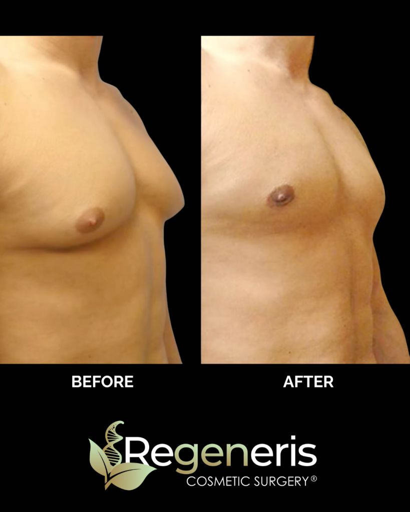 Before and after gynecomastia chest sculpting showing side profile reduction of breast tissue