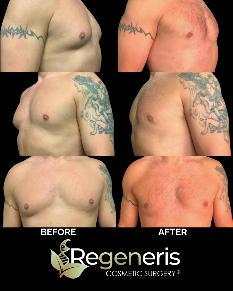 Before and after gynecomastia chest sculpting at multiple angles showing flattened chest contour