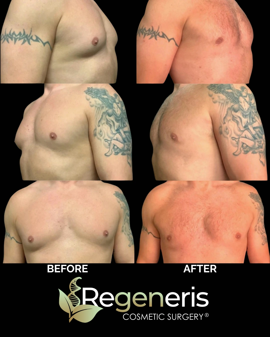 Before and after gynecomastia chest sculpting at multiple angles showing flattened chest contour