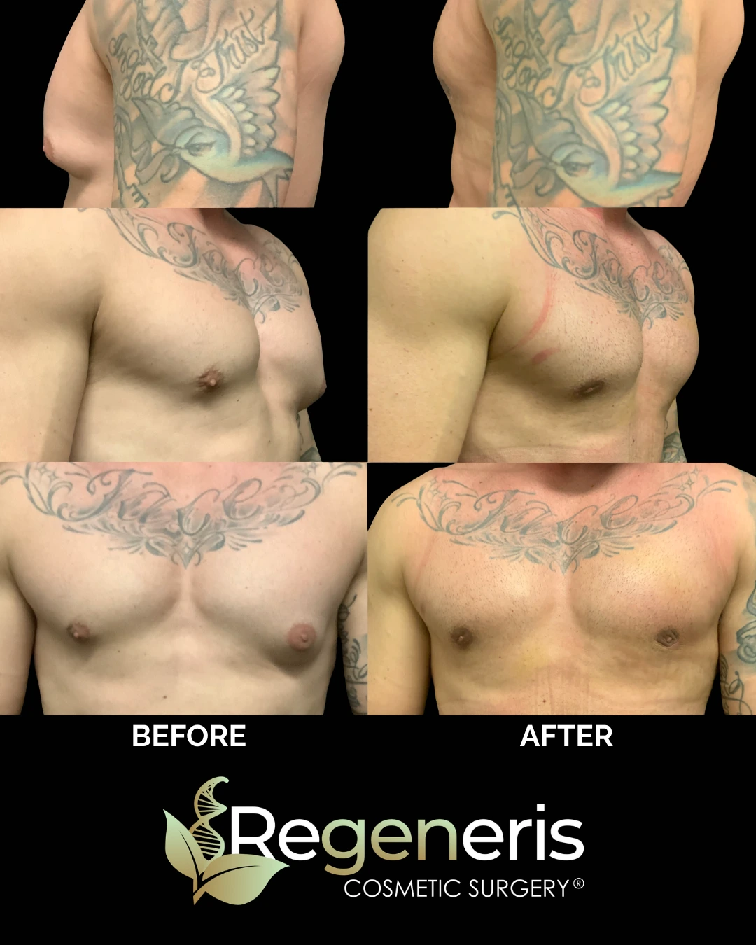 Before and after gynecomastia chest sculpting at front and side angles showing improved chest definition
