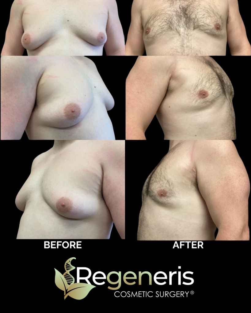 Before and after gynecomastia chest sculpting at front and side angles showing reduced breast tissue