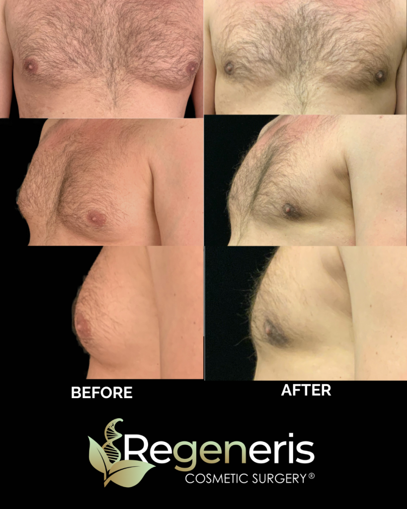 Before and after gynecomastia chest sculpting at front and side angles showing flattened chest appearance