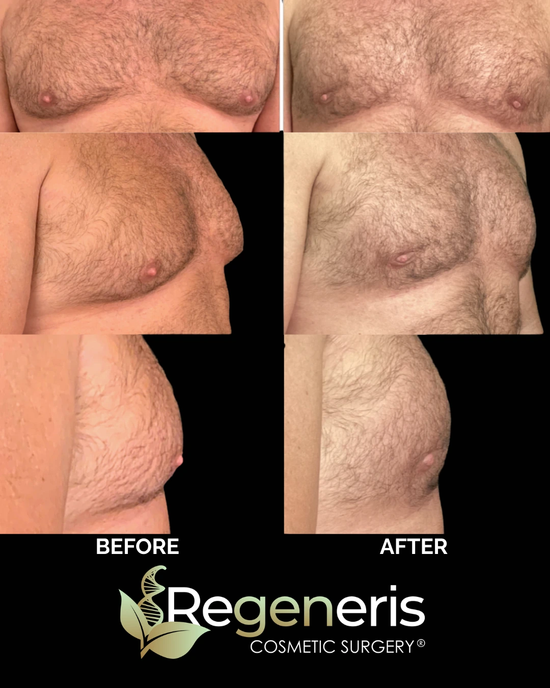 Before and after gynecomastia chest sculpting showing front, side, and profile views with reduced breast tissue