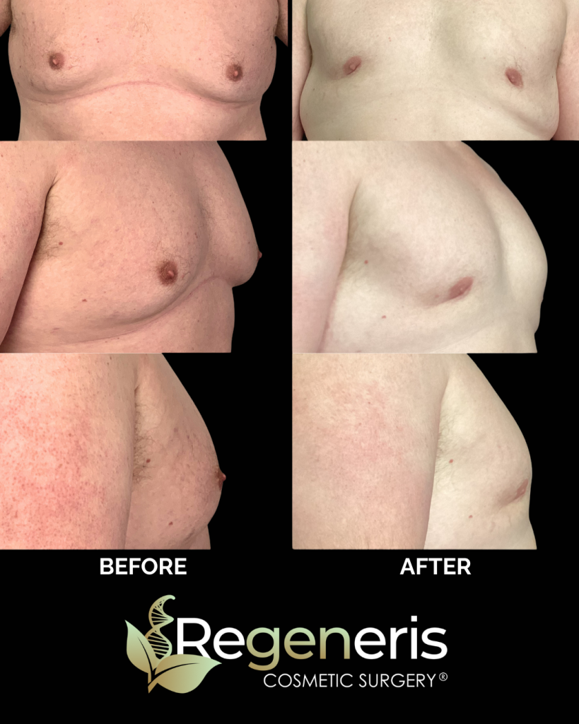 Before and after gynecomastia chest sculpting showing front, side, and profile views with flattened chest contour