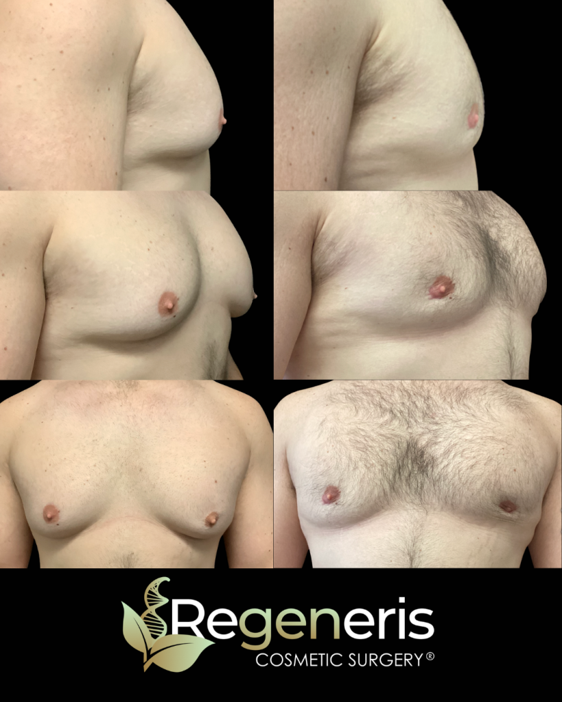 Before and after gynecomastia chest sculpting showing side, angled, and front views with improved chest definition
