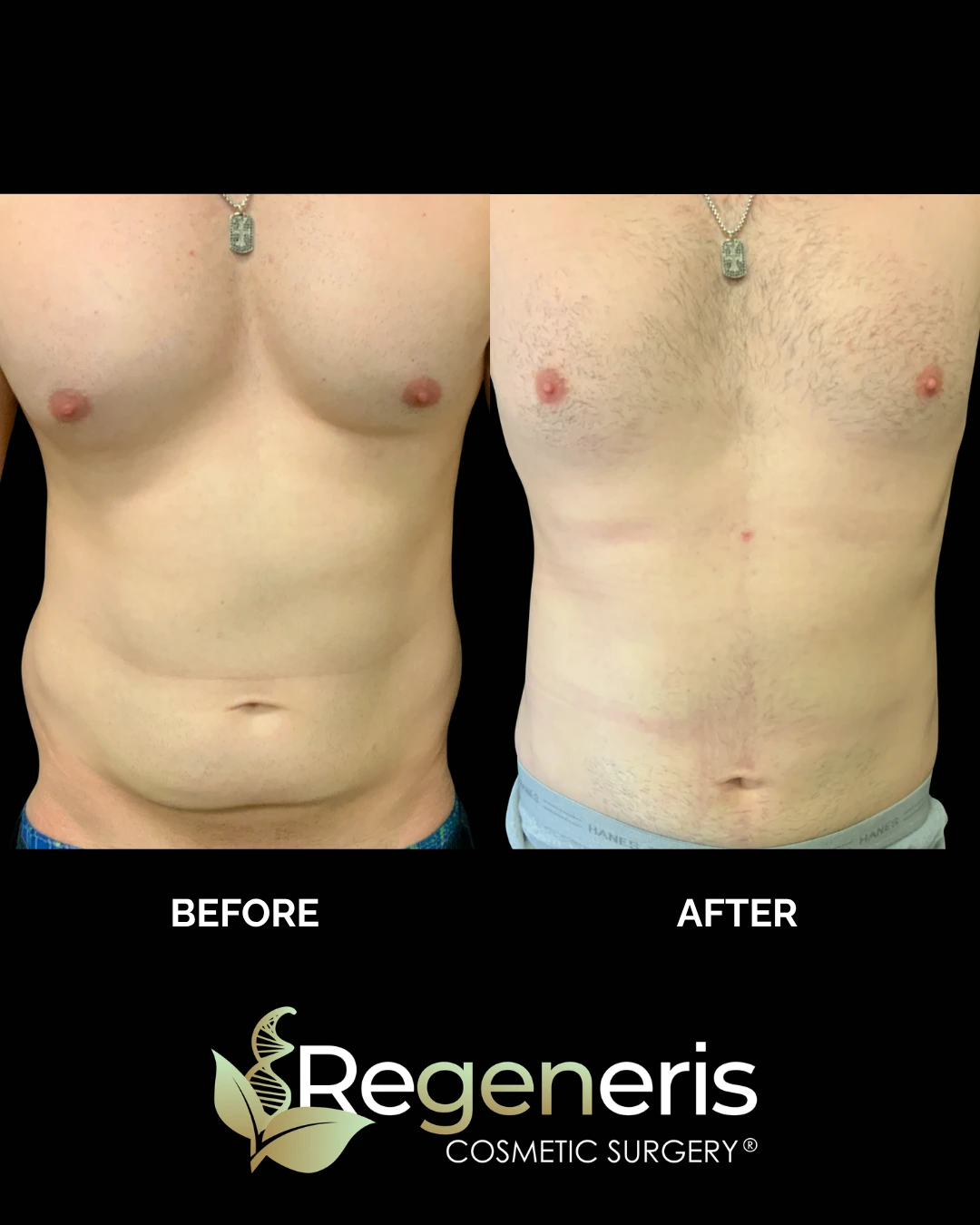 Before and after liposuction: front torso view showing reduced abdominal and chest fat
