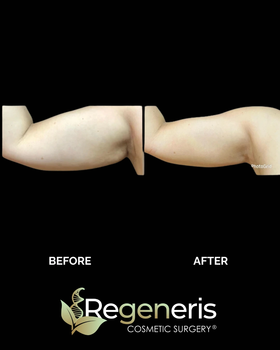 Before and after liposuction and Renuvion treatment showing arm fat reduction and skin tightening