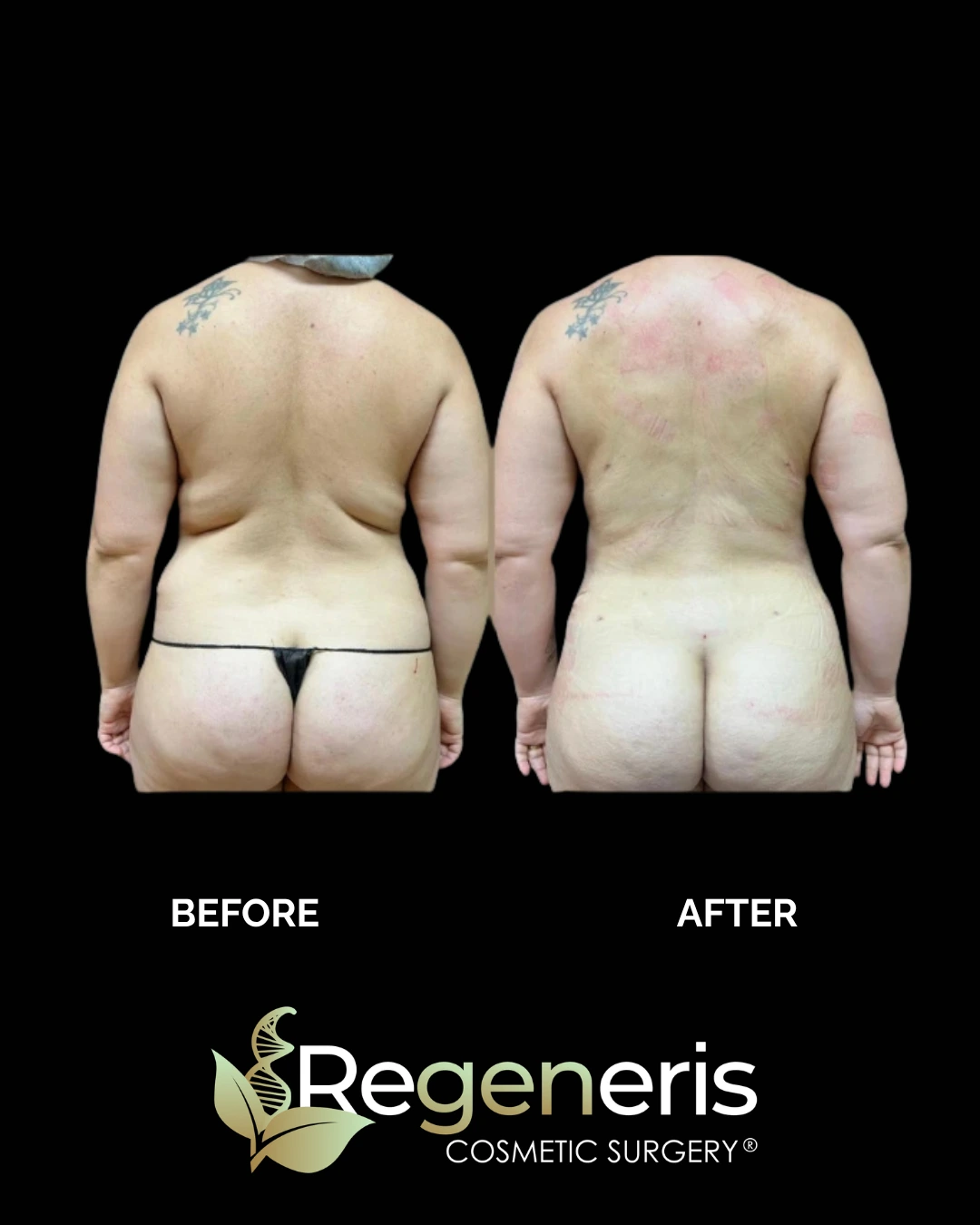 Before and after liposuction and Renuvion treatment showing back and buttock contouring results