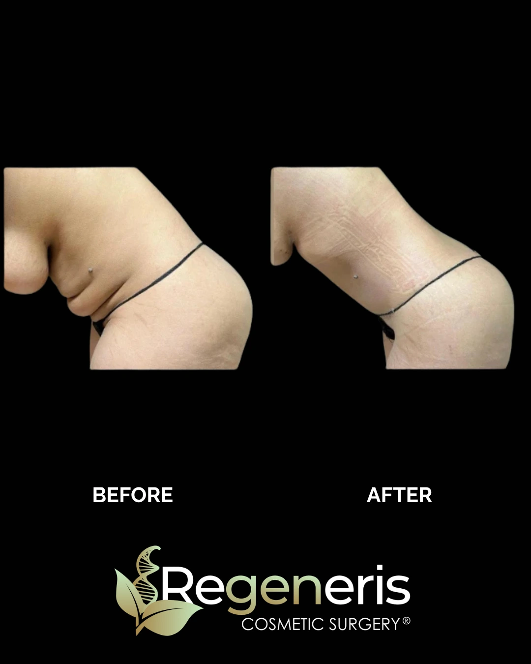 Before and after liposuction and Renuvion treatment to lower back and buttocks area