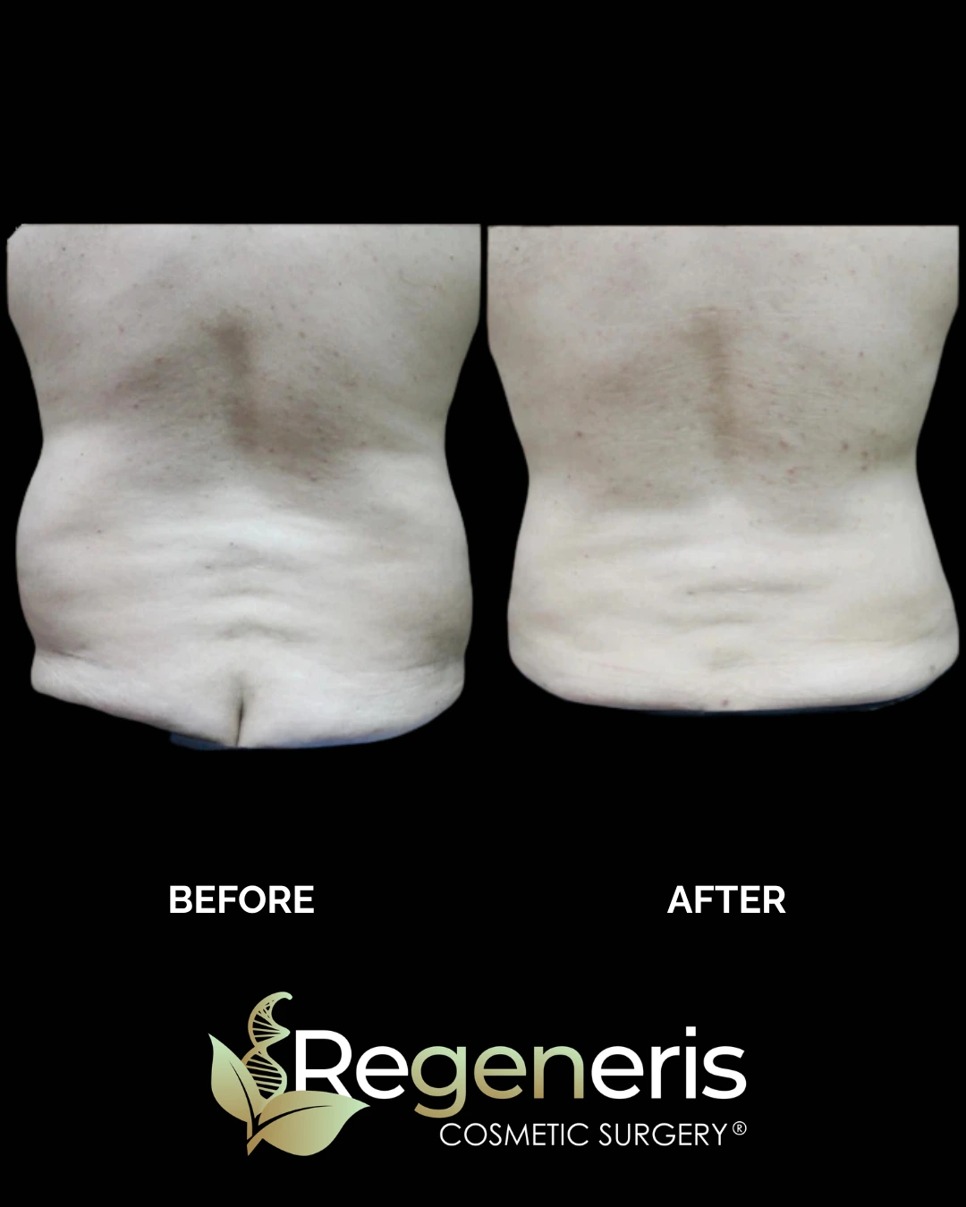 Before and after liposuction and Renuvion treatment to abdomen and flanks