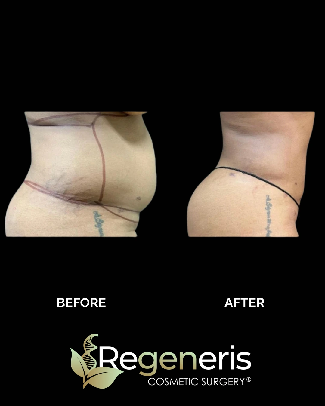 Before and after liposuction and Renuvion treatment to lower abdomen and flanks