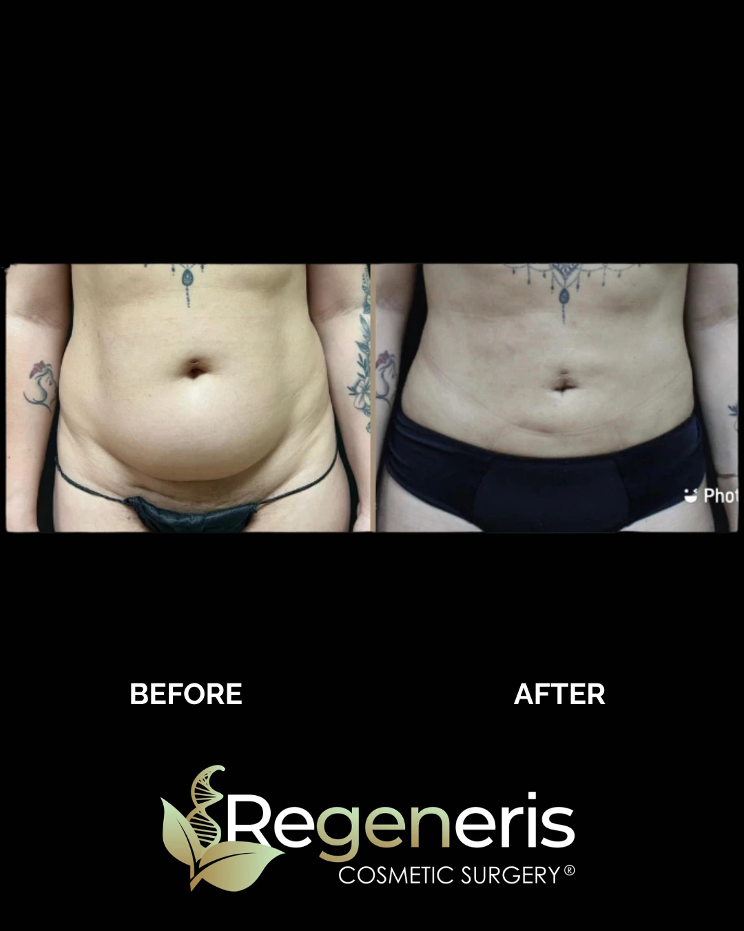 Before and after liposuction and Renuvion treatment to abdomen