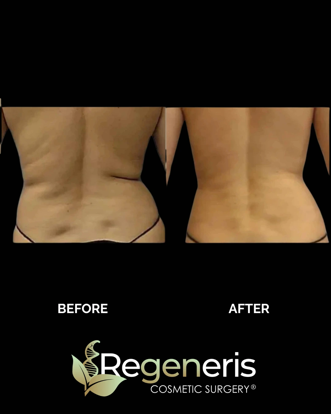 Before and after liposuction and Renuvion treatment to lower back and flanks