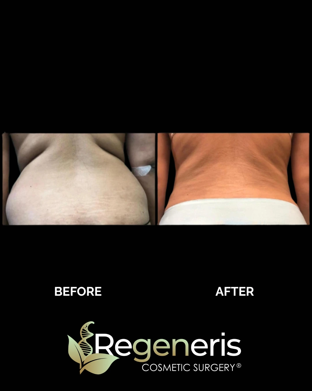 Before and after liposuction and Renuvion treatment to lower back and buttocks
