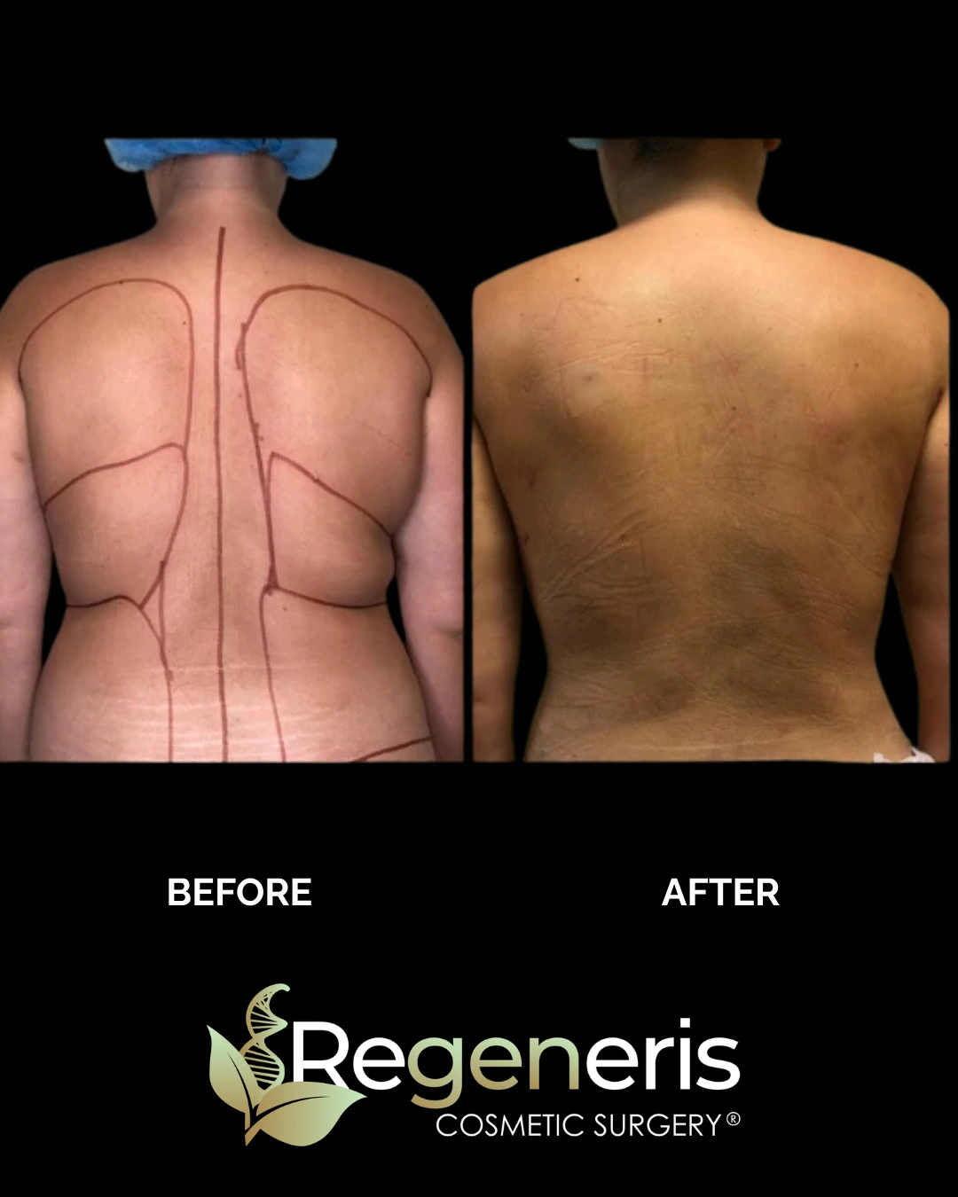 Before and after back view showing liposuction and Renuvion treatment results with reduced fullness