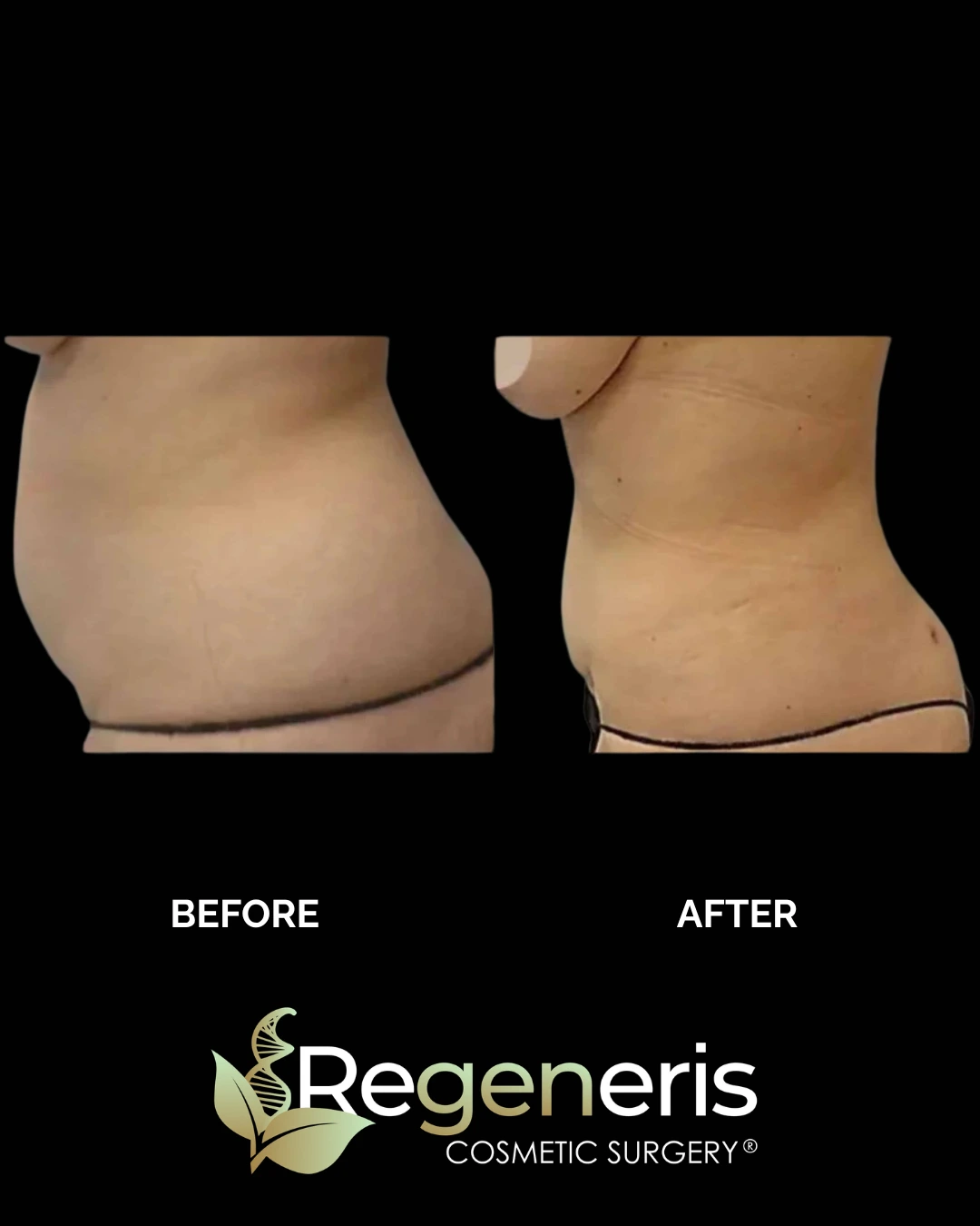 Before and after side view of abdomen showing liposuction and Renuvion results with improved contour