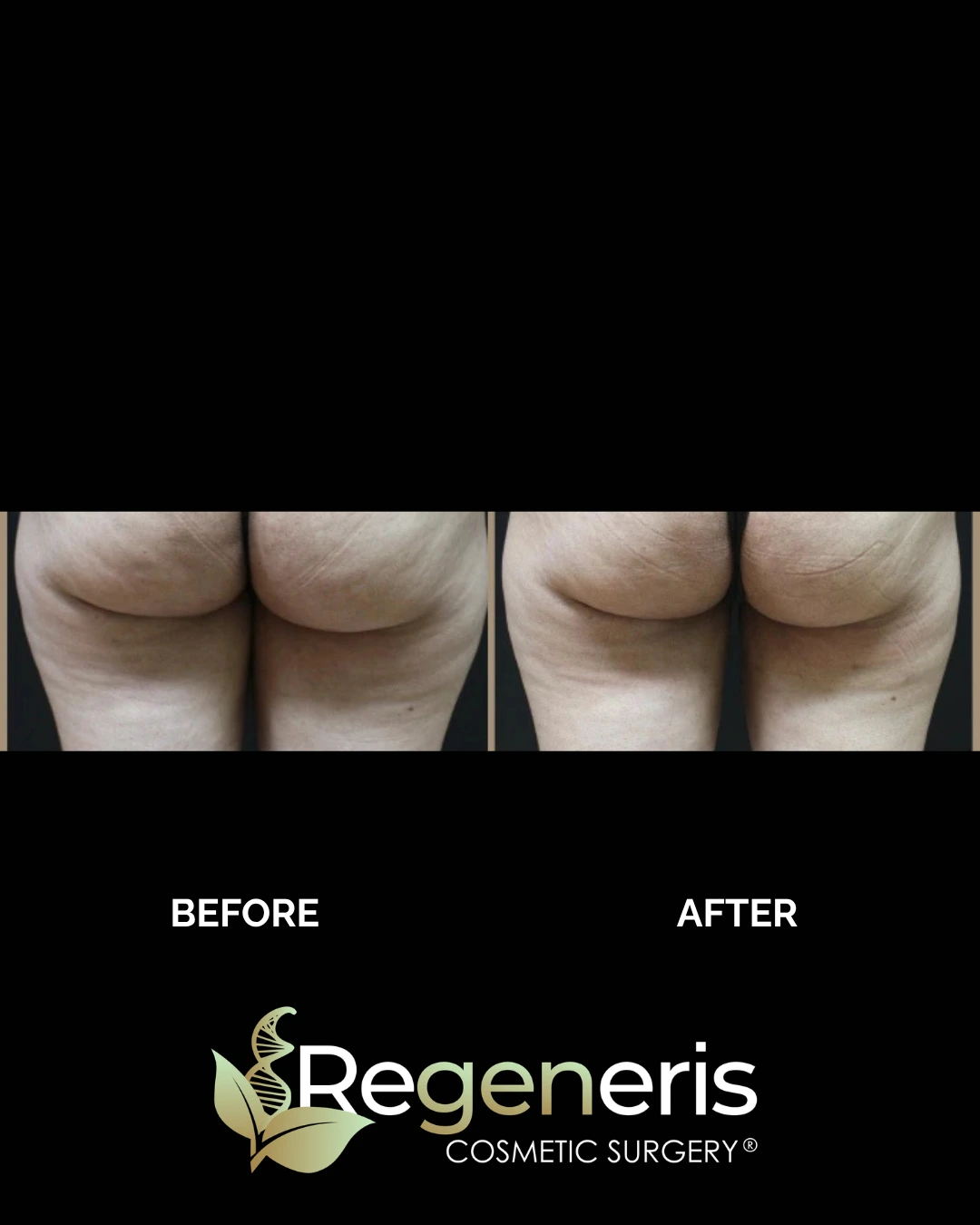 Before and after liposuction with Renuvion: rear view showing reduced cellulite and improved skin tightness