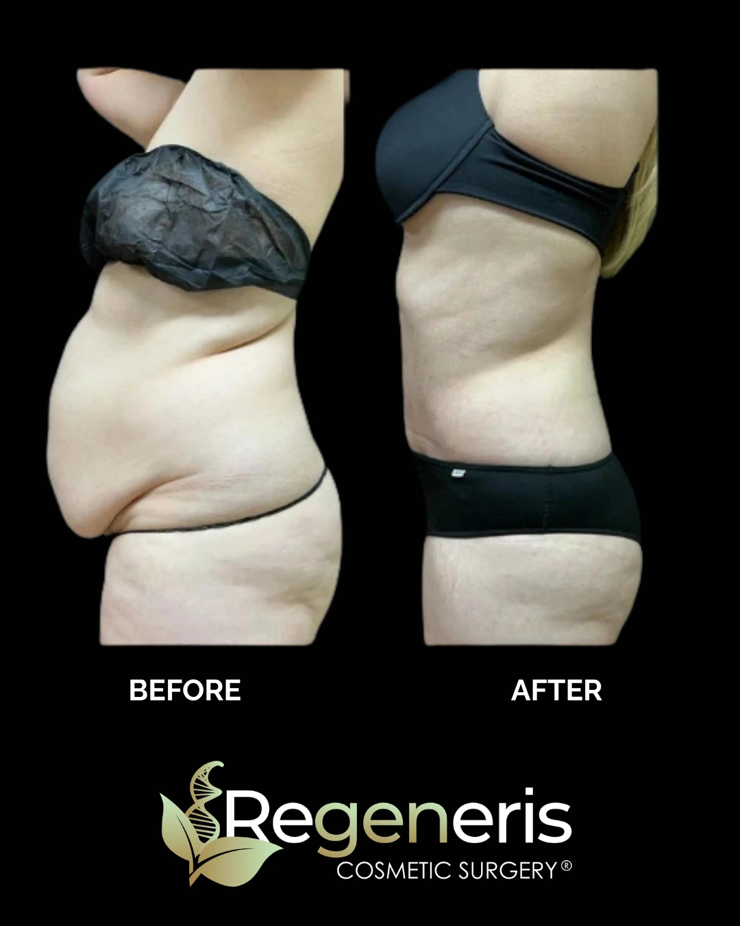 Before and after side view showing liposuction and Renuvion treatment of flanks and abdomen