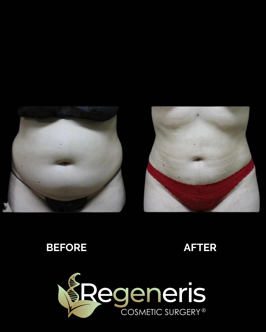Before and after frontal view of abdomen showing liposuction and Renuvion results with flattened contour