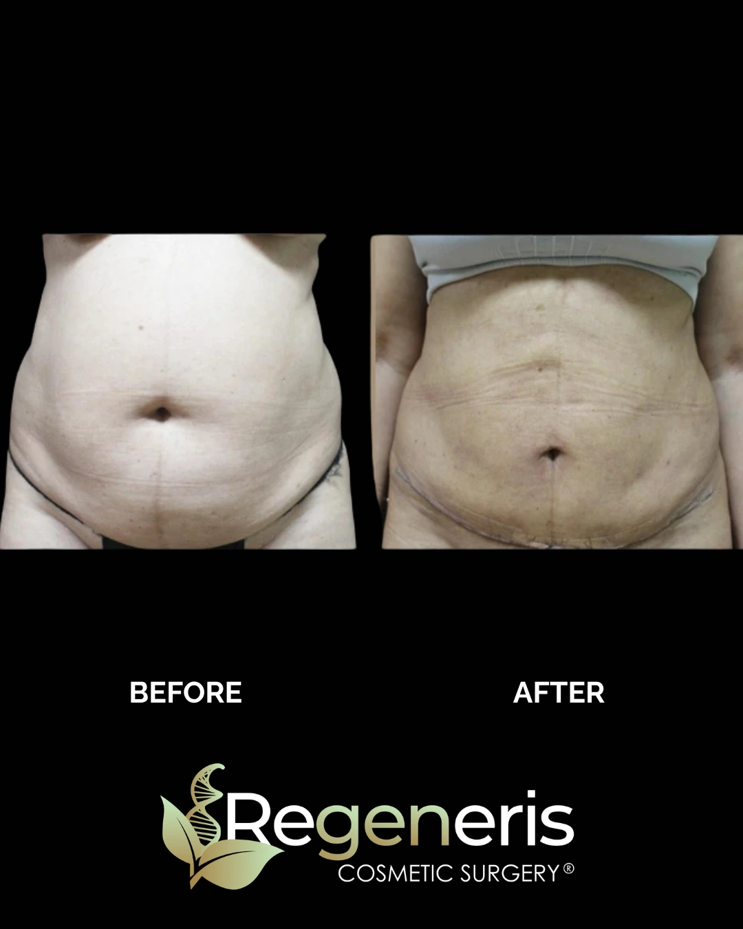 Before and after frontal view of abdomen showing liposuction and Renuvion treatment with refined shape