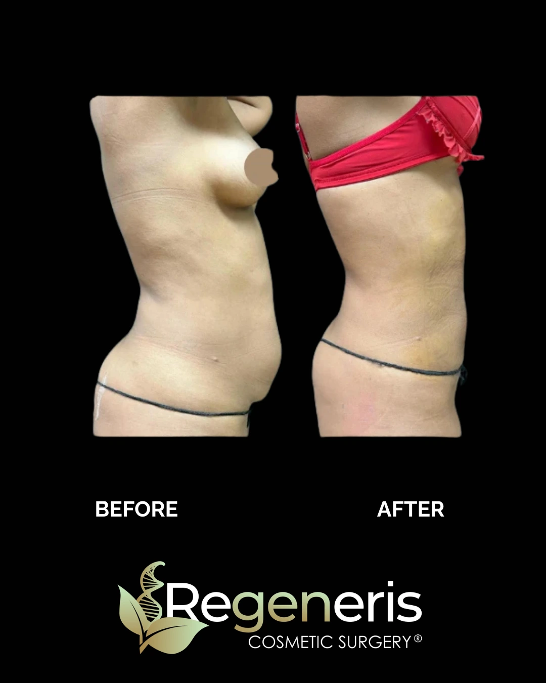 Before and after side view showing liposuction and Renuvion results of flanks and waistline