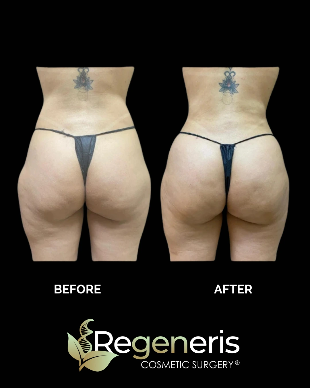 Before and after liposuction and Renuvion treatment showing reduced lower body volume and improved skin tightness
