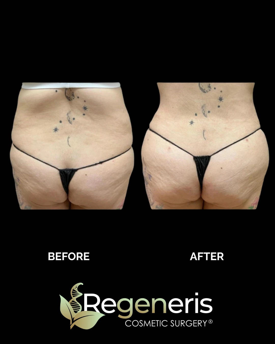 Before and after liposuction with Renuvion: lower back and buttocks showing improved definition and reduced laxity