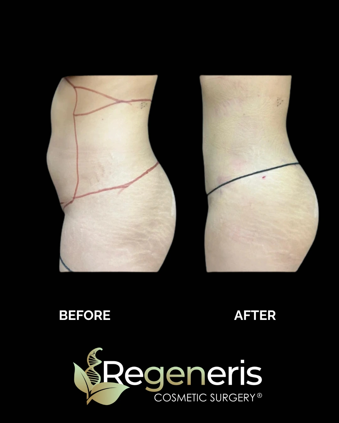 Before and after liposuction with Renuvion: side view showing reduced waist fat and tighter skin