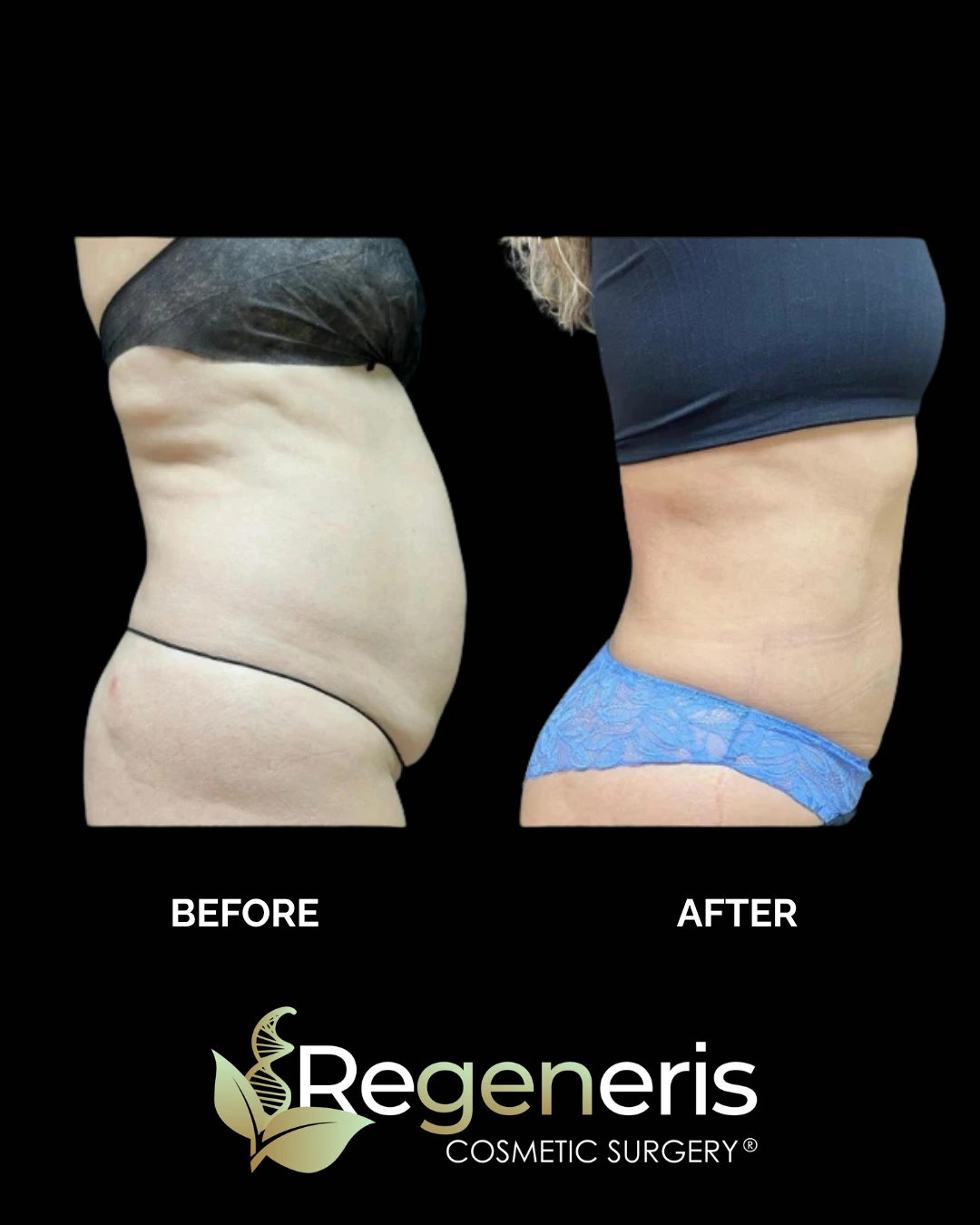 Before and after liposuction with Renuvion: side torso view showing flatter abdomen and improved skin quality