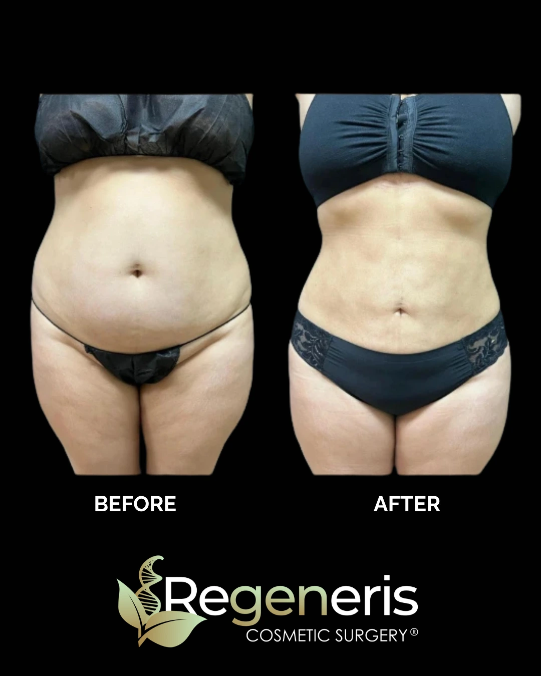 Before and after liposuction and Renuvion treatment showing abdominal contouring results