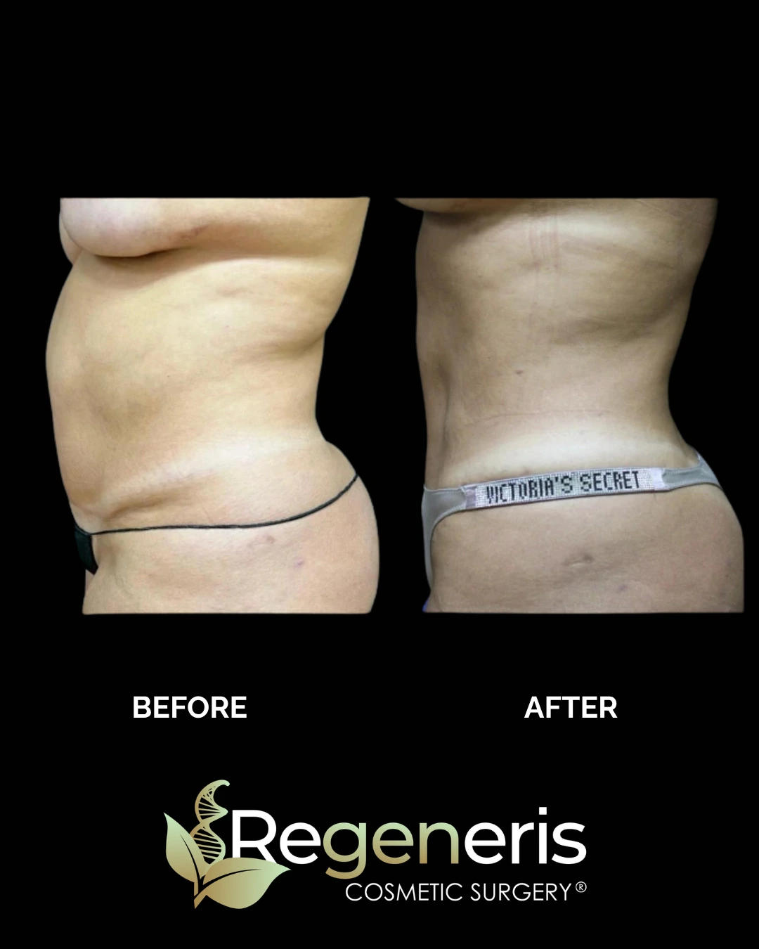 Before and after liposuction and Renuvion treatment showing side flank and waist definition