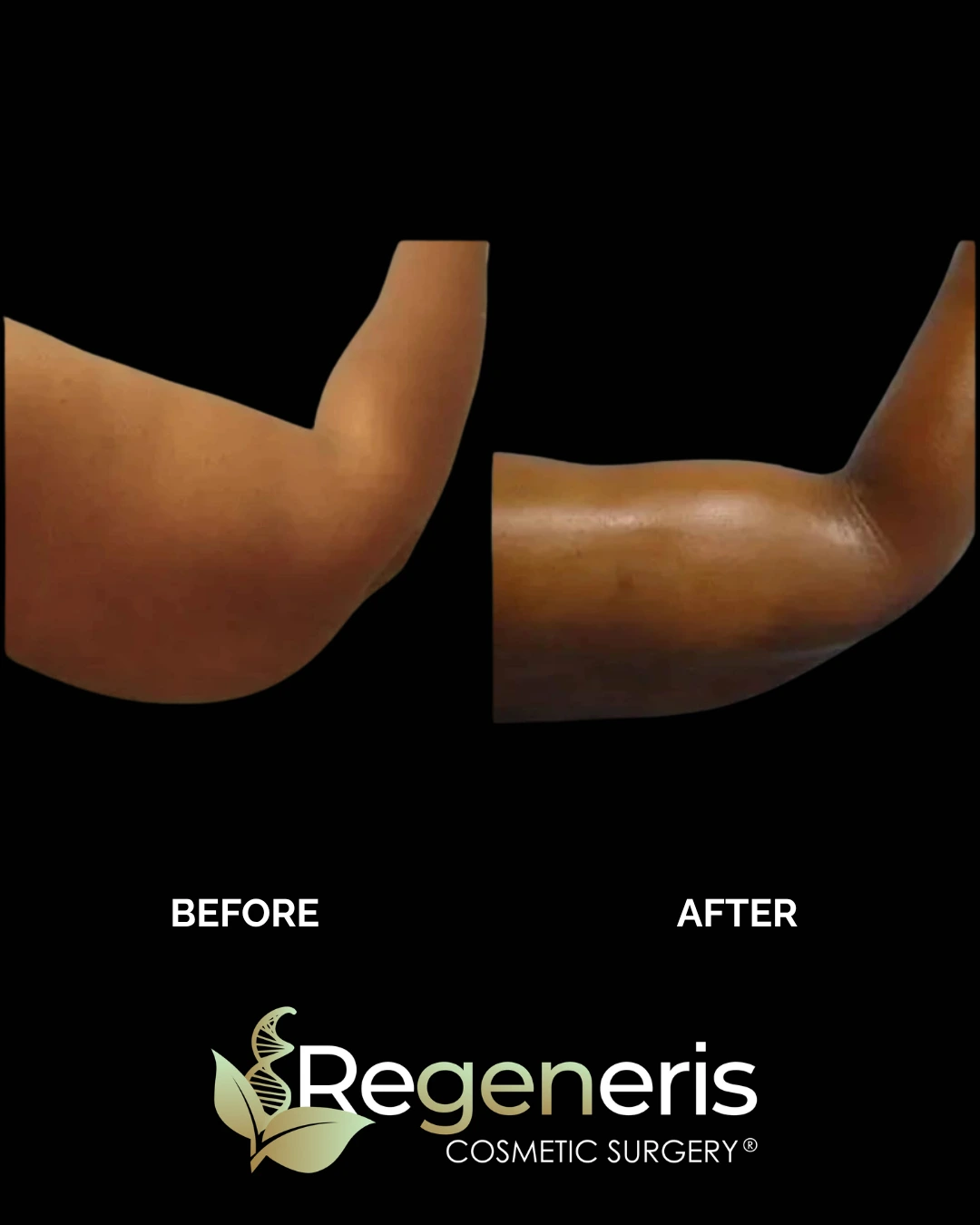 Before and after liposuction and Renuvion treatment showing arm contouring results