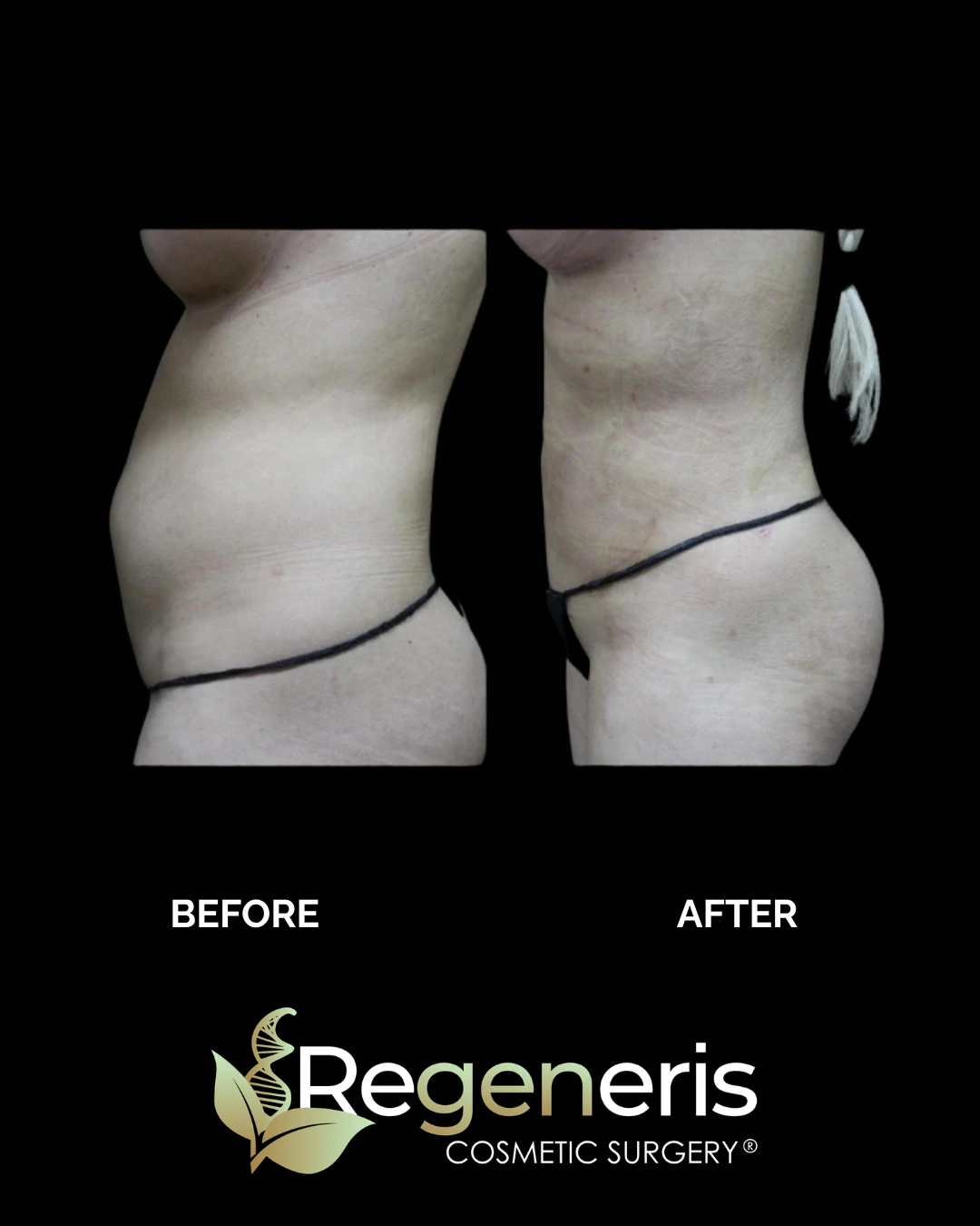 Before and after liposuction and Renuvion treatment showing abdominal and flank tightening