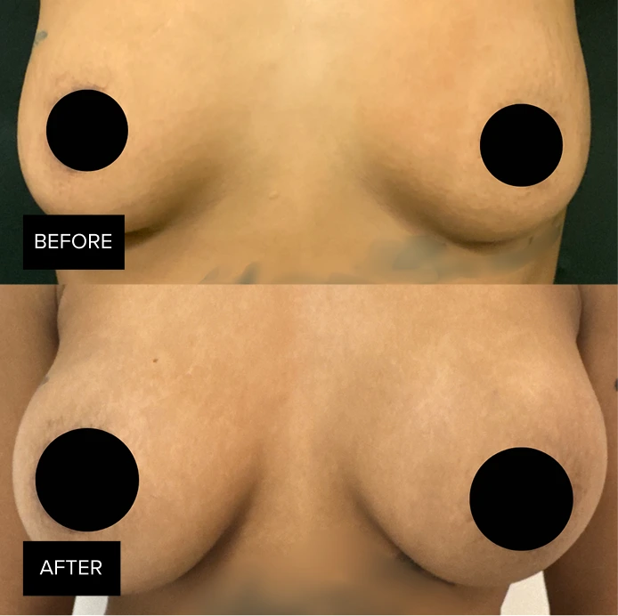 Before and after breast augmentation results showing increased lift and volume