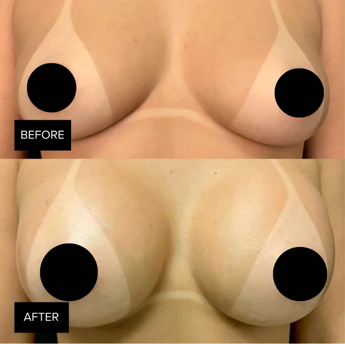 Before and after breast augmentation results showing enhanced size and contour