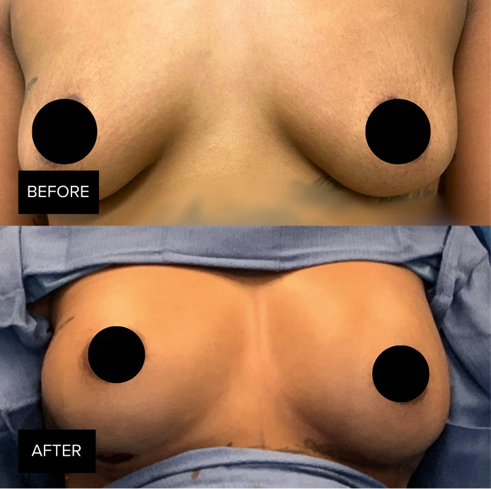 Before and after breast augmentation results showing improved shape and fullness
