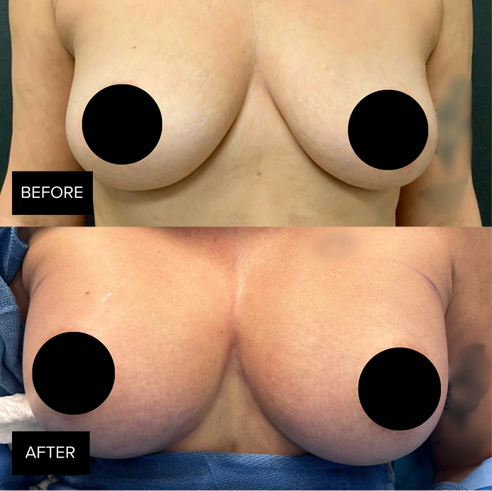 Before and after breast augmentation results showing increased volume and projection