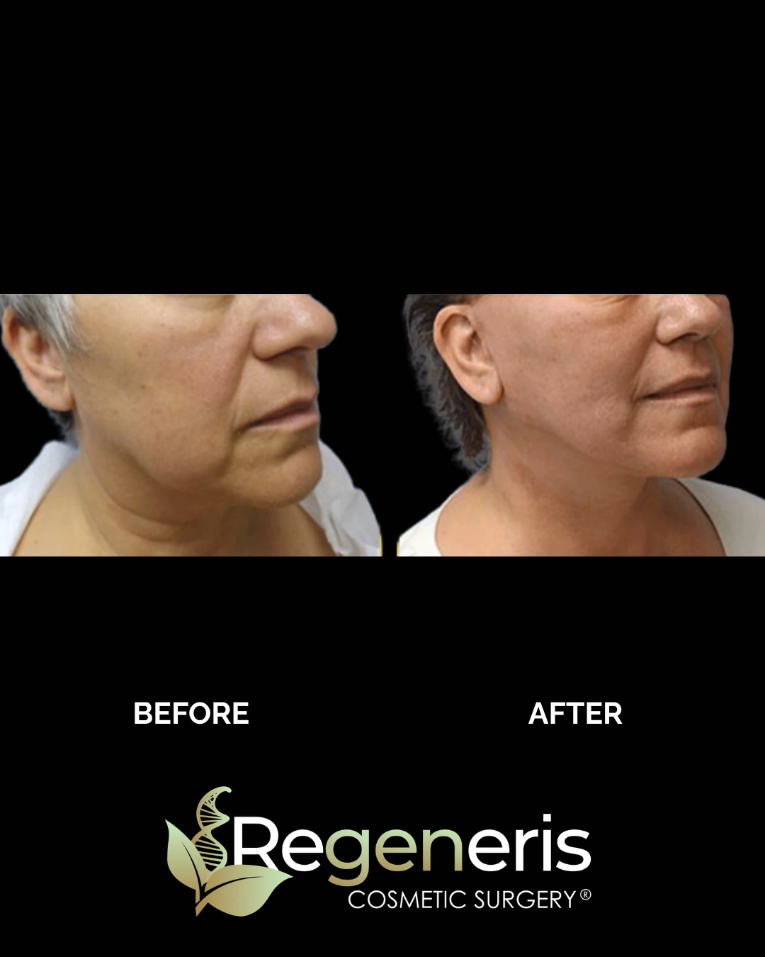 Before and after profile views of facelift results showing improved facial contour and skin tightness