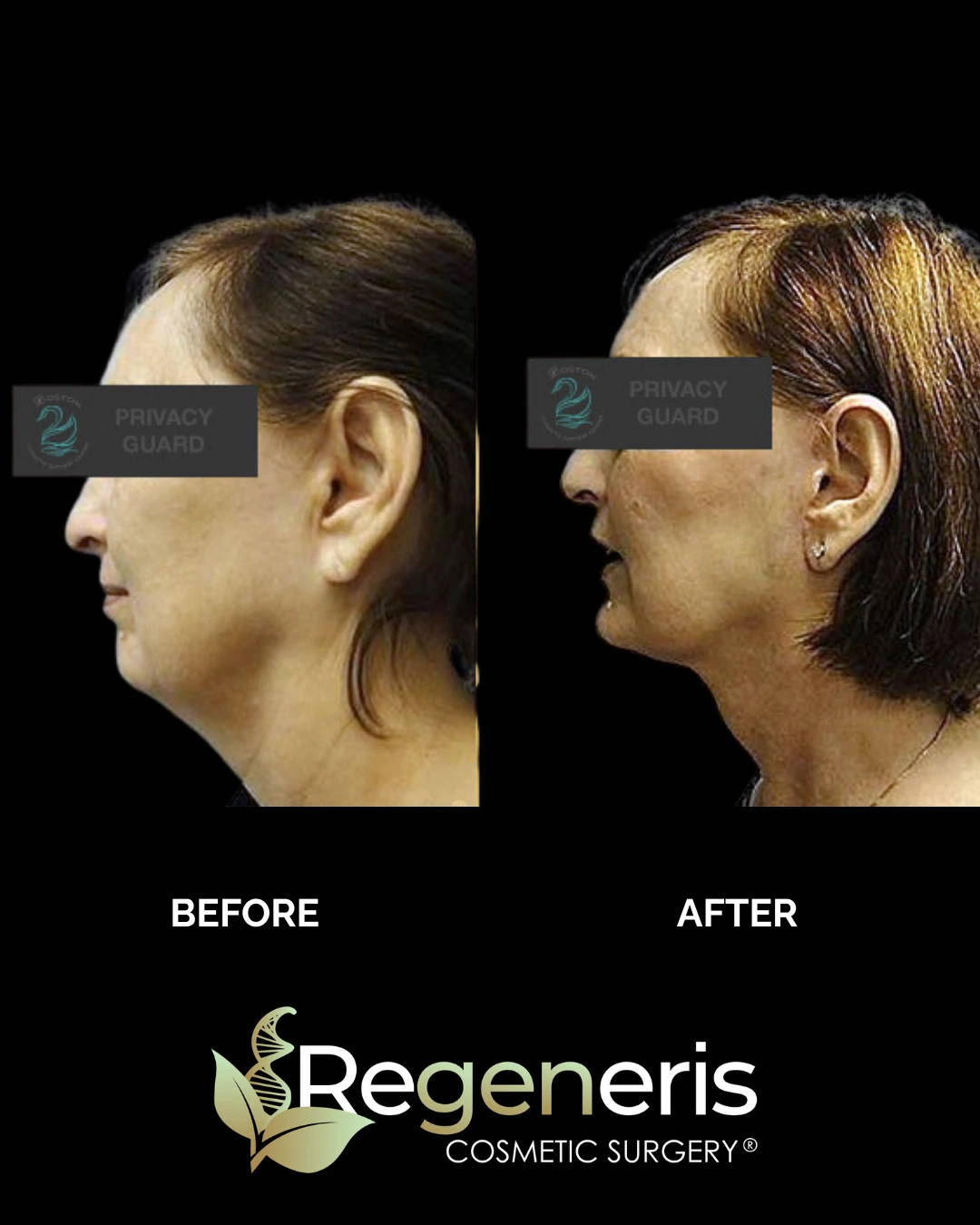 Before and after facelift: patient profile showing improved jawline and neck definition