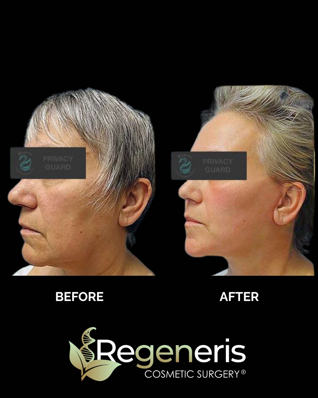 Before and after facelift: patient profile showing lifted cheeks and refined facial contours