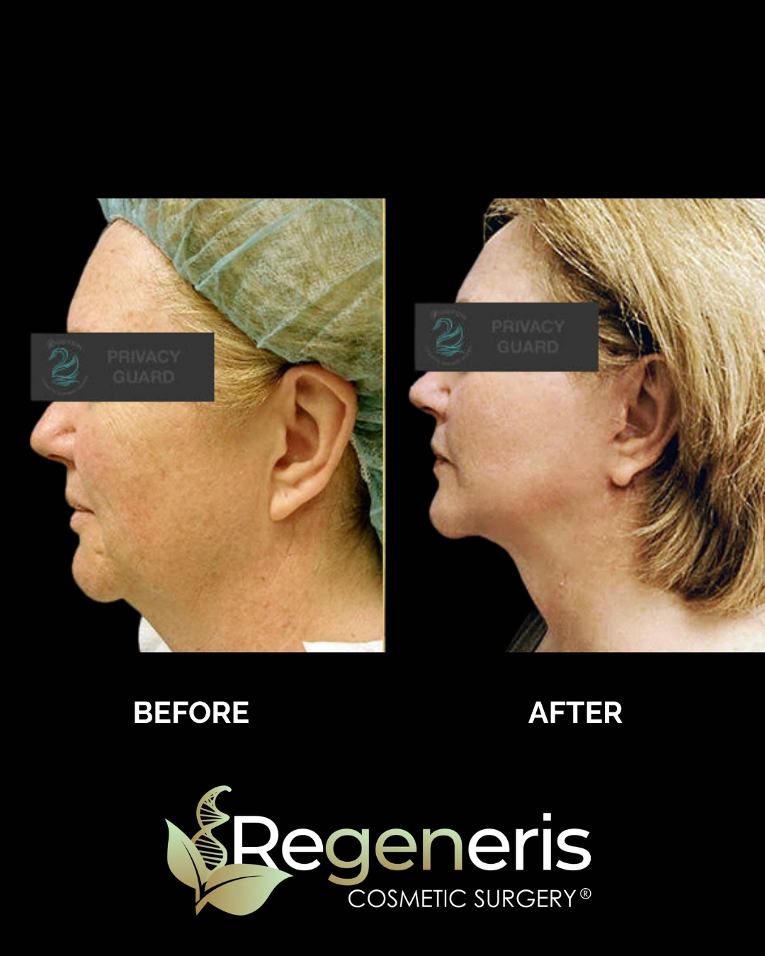 Before and after facelift: patient profile showing tightened jawline and reduced sagging