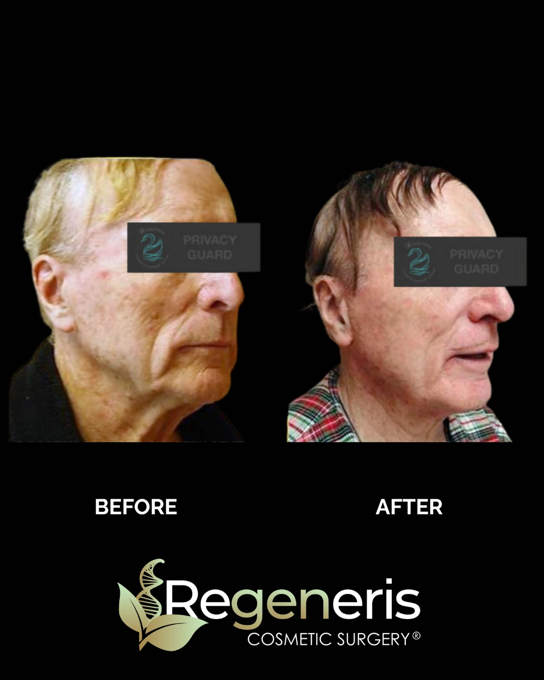 Before and after facelift: patient profile showing improved skin texture and facial rejuvenation